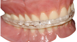 AvaDent_occlusal_lockingsplint