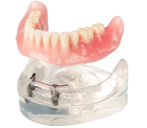 AvaDent overdenture header