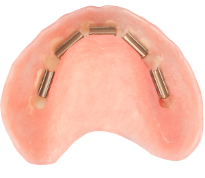 AvaDent overdenture 02