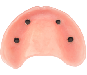 AvaDent overdenture 01