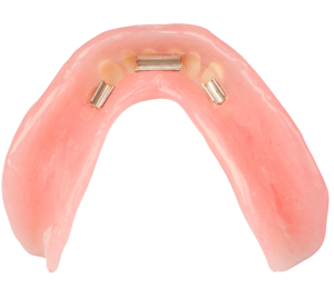 AvaDent overdenture 03