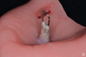 Retention between milled IMAGE