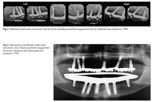 THIRTY-TWO–YEAR SUCCESS OF DENTAL IMPLANTS-300x200