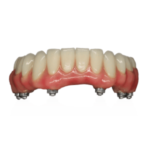 Implant Supported Dentures