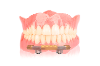 Overkappingsprothese met nieuwe steg