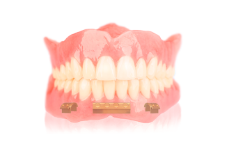 Overkappingsprothese op bestaande steg