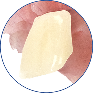 eigenschap-protheses_accelerset-element