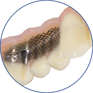 eigenschap-protheses_in_1_keer_gefreesd