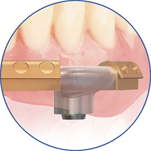 eigenschap-protheses_steg