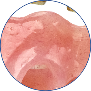 eigenschap_protheses_accelerset-intaglio